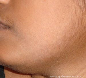 Vitiligo-After